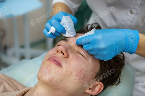 Preview: Treatment of acne in adolescents. Facial peeling to fight acne on the face