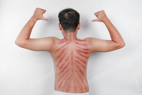 Preview: Red marks from scrapes coin on a man's back called Kerokan.