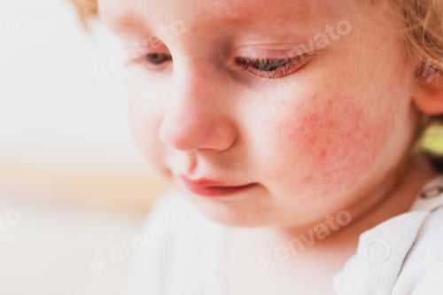Preview: food allergies, eczema, or diathesis in a small child on the cheeks