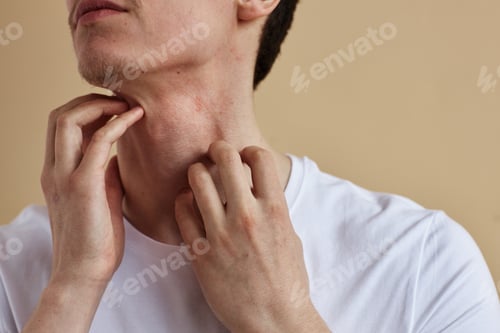 Preview: Close up of man scratching neck itch and allergies