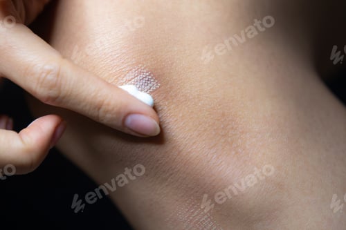 Preview: Marks after laser hair or scar removal from the skin. CO2 technique.