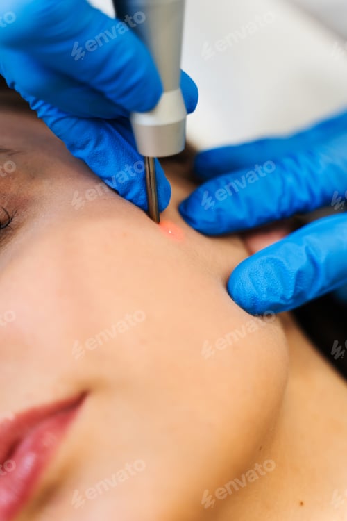 Preview: Laser skin cleansing procedure performed by cosmetologist