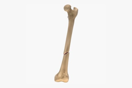 Preview: Human Femur with Oblique Fracture