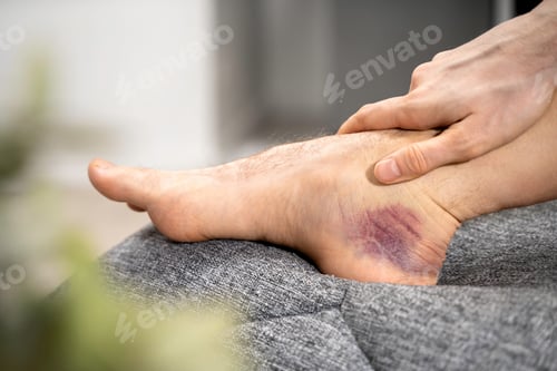 Preview: Close-up bruised male ankle with deep blue purple hematoma after leg injury