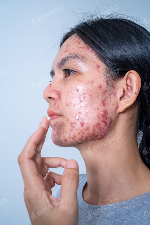Preview: Acne on face because the disorders of sebaceous glands productions. Acne or a Cosmetic Allergy.