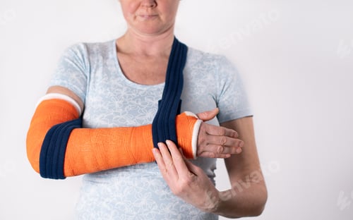 Preview: middle aged woman with broken arm in cast hangs her arm in a sling, modern treatment methods, on a