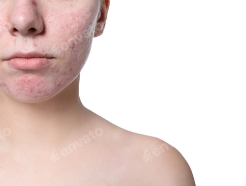 Preview: Young woman with acne problem on white background
