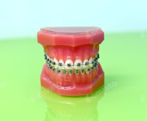 Preview: Model of dental appliance showing braces