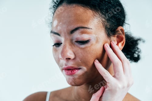 Preview: Beautiful woman with vitiligo skin