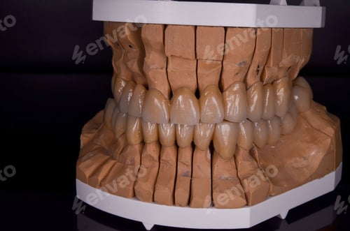 Preview: Close-up shot of metal-ceramic crowns on a reflective black surface