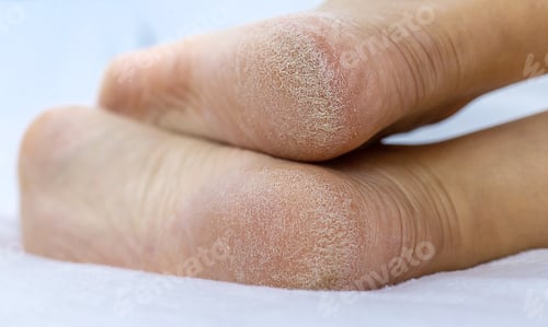 Visualização: Pés femininos: pele seca nos calcanhares. Foco seletivo.