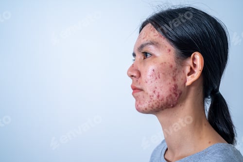 Preview: Acne on face because the disorders of sebaceous glands productions. Acne or a Cosmetic