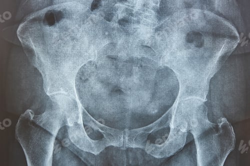 Preview: Hip xray. Human skeleton. Pelvis and femur bone. Osteoporosis