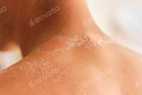 Preview: unrecognizable guy got sunburn and got tan lines on his back.