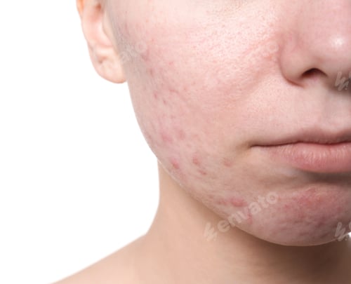 Preview: Young woman with acne problem on white background