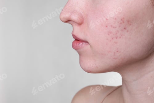 Preview: Young woman with acne problem on light grey background, closeup. Space for text