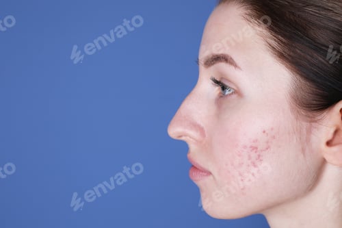 Preview: Young woman with acne problem on blue background, closeup. Space for text