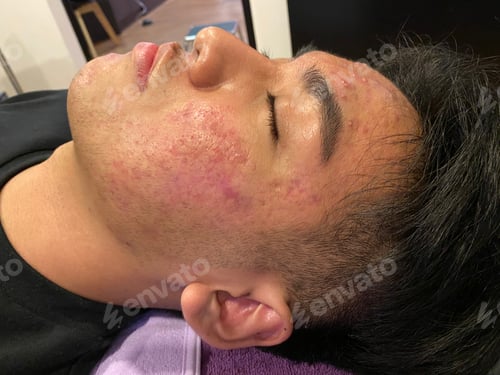Preview: Acne problems and deep scarring on a teenage boy face