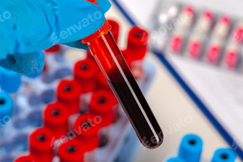 Preview: Blood test tube for analysis. 2019-nCoV virus infection originating in Wuhan, China