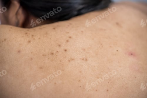 Preview: Acne on the back of the skin care woman is caused by bacteria.