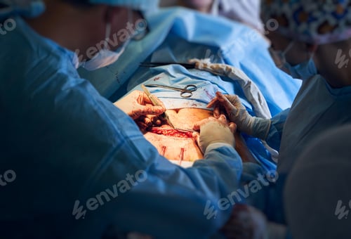 Preview: Doctors in sterile gloves doing abdominoplasty surgery in clinic.