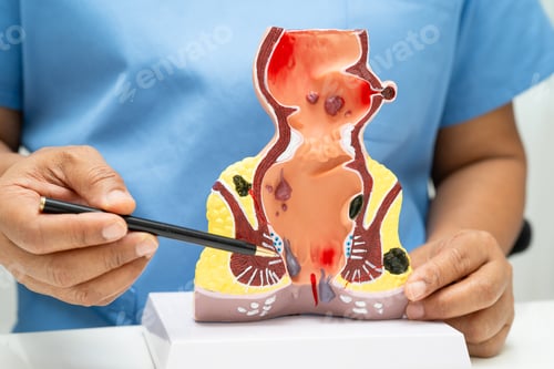 Preview: Asian doctor with rectum and hemorrhoid human anatomy model