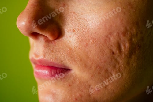 Preview: post-acne, scars and red festering pimples on the face of a young woman.