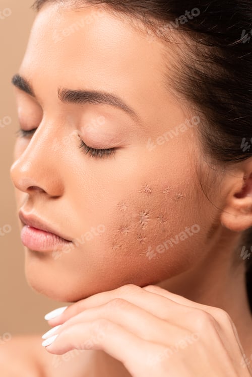 Preview: young woman with closed eyes and acne on face isolated on beige