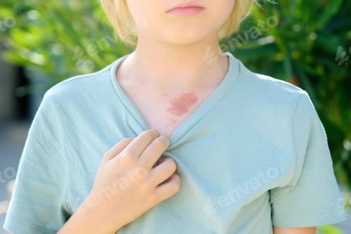 Preview: Mark on the skin of chest of eight years old child