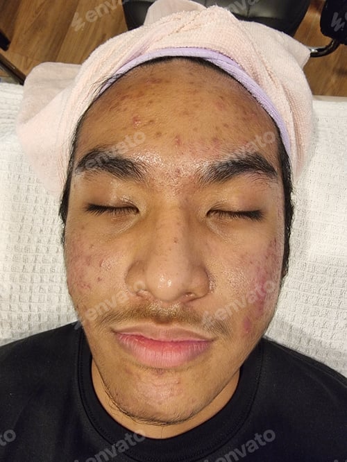Preview: Acne problems and deep scarring