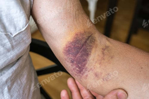 Preview: injury ligament arm bruise