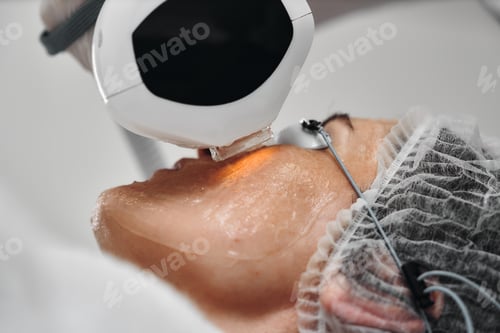 Preview: Laser treatment session on a patients face at a skincare clinic