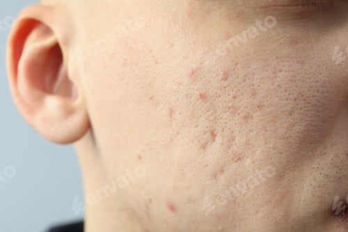 Preview: Concept of skin care with problem skin, close up