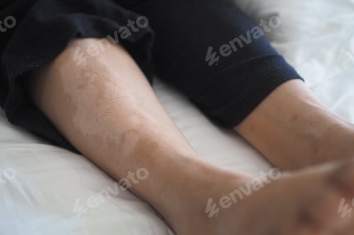 Preview: feet with vitiligo skin condition.