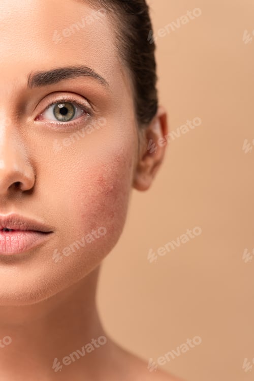 Preview: cropped view of girl with problem skin looking at camera isolated on beige