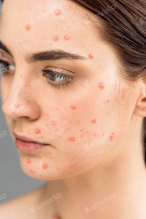 Preview: close up of young brunette woman with pimples on face isolated on grey