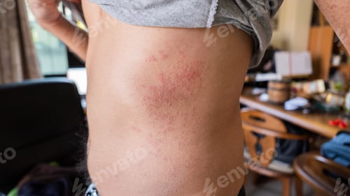 Visualização: Man With Dermatitis Problem Of Rash