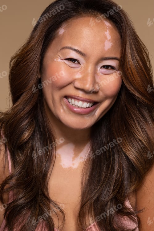 Preview: Studio Portrait Of Beautiful Southeast Asian Woman In Her 30S With Vitiligo Skin Condition Smiling