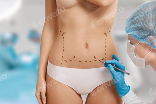 Preview: Plastic Surgery Doctor Draw Line On Patient Breast Augmentation Implant. Woman Belly Marked Out For