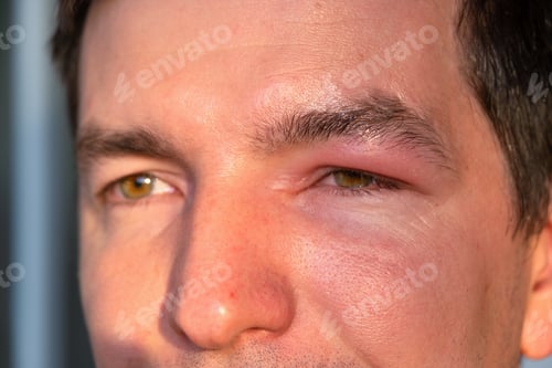 Preview: Upper eyelid swelling, allergy to bee sting, risk of anaphylaxis, pain, redness, local infection, po