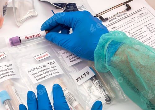 Preview: Nurse analyses positive PCR tests of Hantavirus in a hospital laboratory