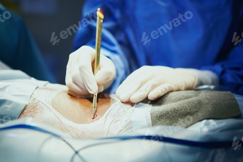 Preview: Person, doctor and hands with cut in operating room for surgery operation or procedure