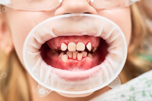 Preview: Close up of child mouth with dental retractor showing crowded teeth and bite misalignment