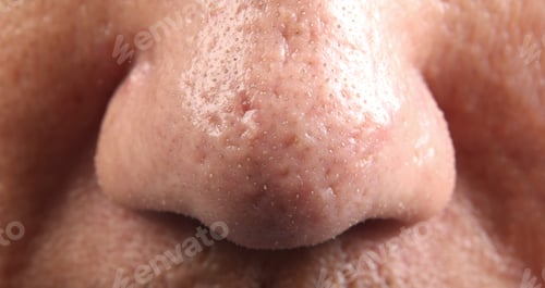 Preview: Macro close up of facial skin and nose. showing visible pores blackheads acne