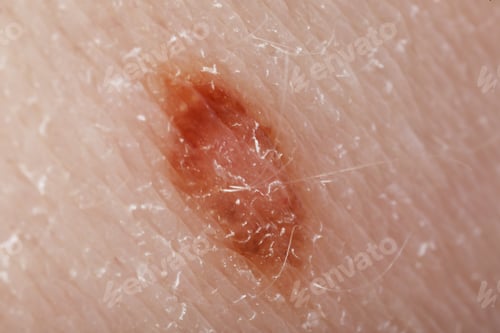 Preview: Macro view of skin with birthmark as background