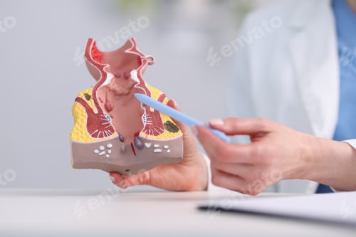Preview: Doctor showing model of unhealthy lower rectum in clinic, closeup