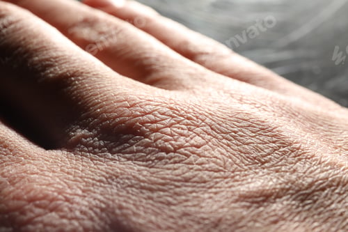 Preview: Man with dry skin on his hand against blurred background, closeup