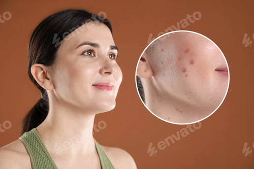 Preview: Woman before and after acne treatment, closeup. Collage showing difference on brown background