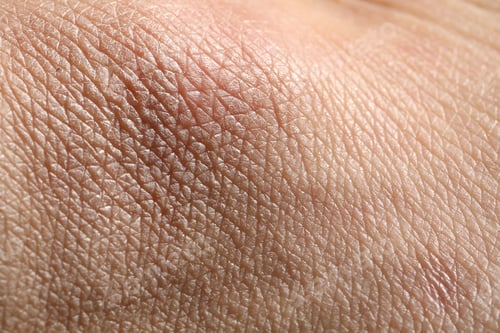Preview: Man with dry skin on his hand, closeup