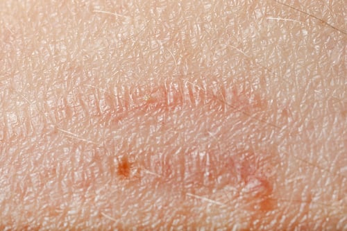 Preview: Macro view of skin with birthmarks as background